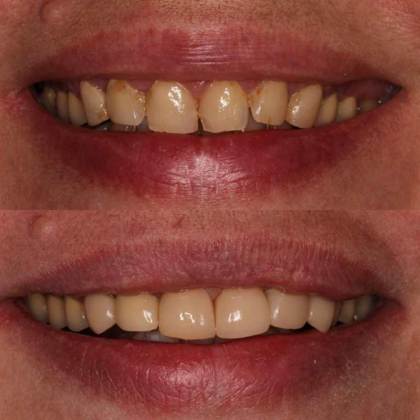 Способ изоляции при восстановлении сильно разрушенных зубов