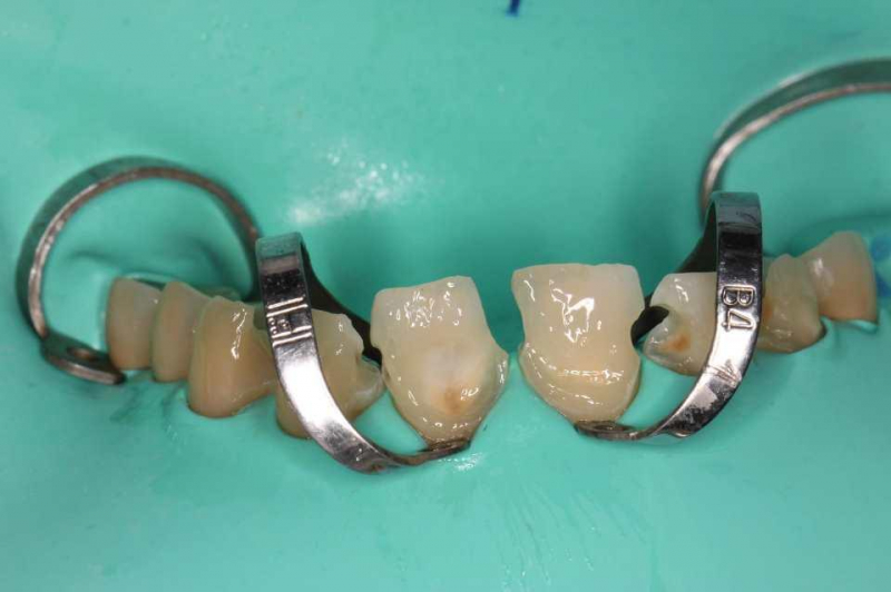 Способ изоляции при восстановлении сильно разрушенных зубов