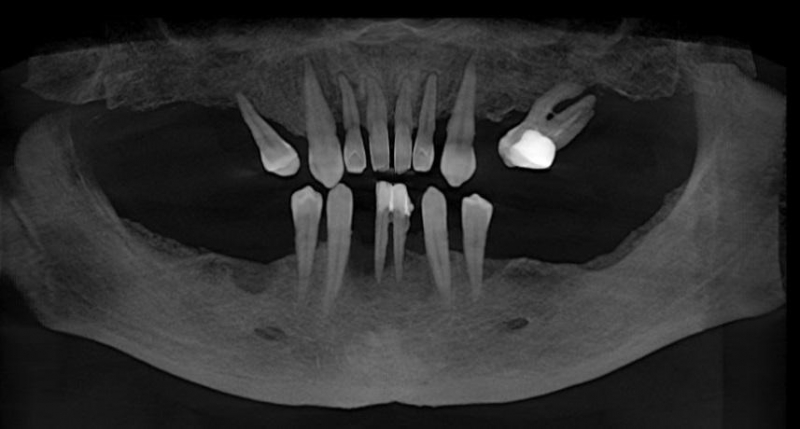 Тотальная реабилитация пациента на имплантатах Dentis. Цифровые и аналоговые решения для построения окклюзии, функциональной адаптации и превосходной эстетики.