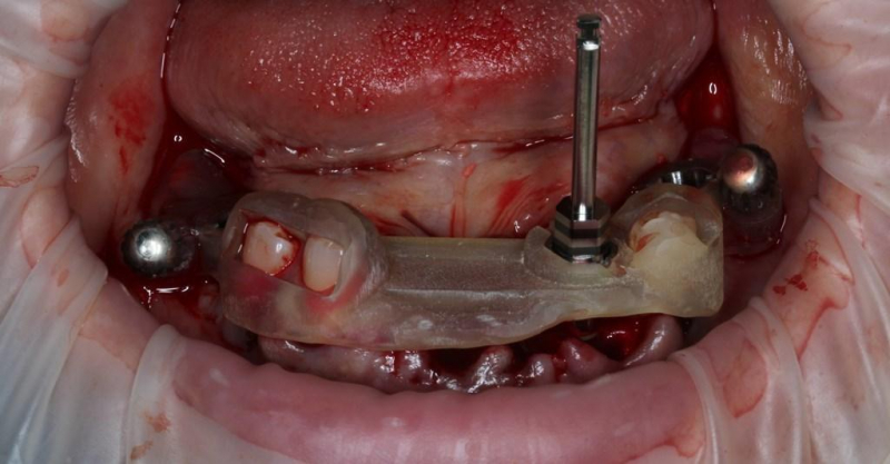 Тотальная реабилитация пациента на имплантатах Dentis. Цифровые и аналоговые решения для построения окклюзии, функциональной адаптации и превосходной эстетики.