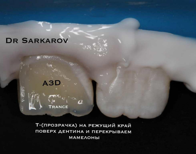 Травма 11 зуба со вскрытием рога пульпы