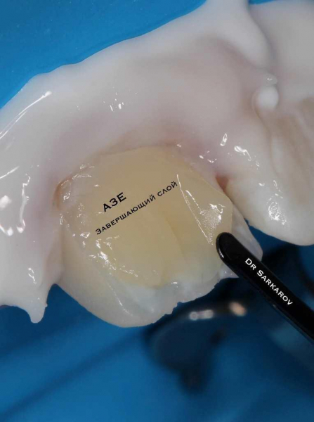 Травма 11 зуба со вскрытием рога пульпы