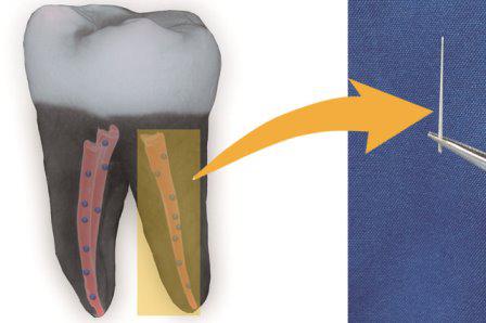 Найден способ сохранять зубы после лечения корневых каналов с помощью ультрадисперсных алмазов