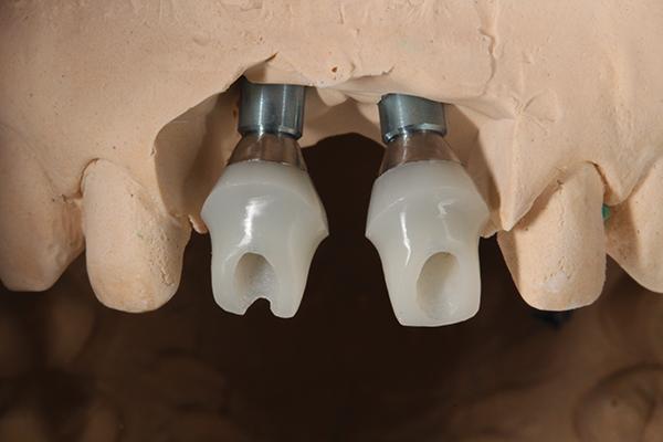 Ортодонтическая экструзия при комплексной реабилитации улыбки
