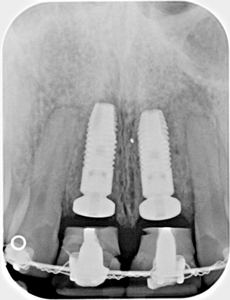 Ортодонтическая экструзия при комплексной реабилитации улыбки