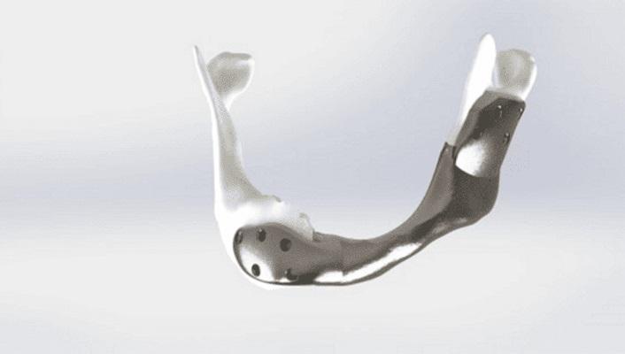 Первая титановая челюсть, напечатанная на 3D-принтере, установлена больному раком