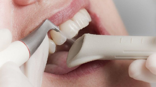 5 причин возникновения зубного камня и способы профилактики