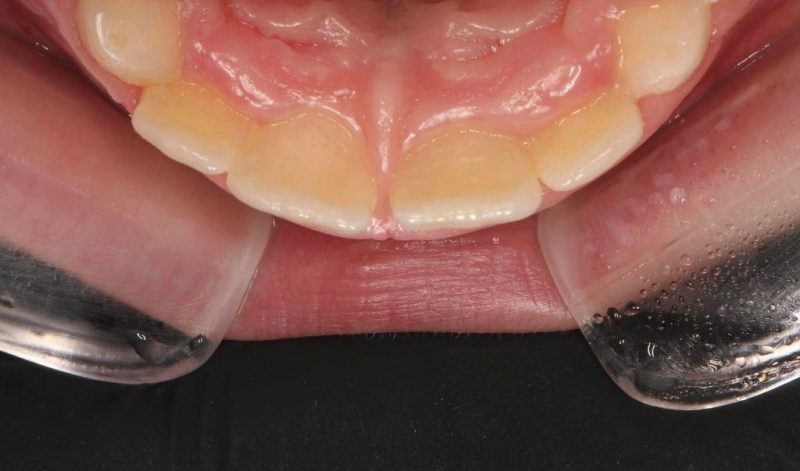 Травма зуба со вскрытием нерва