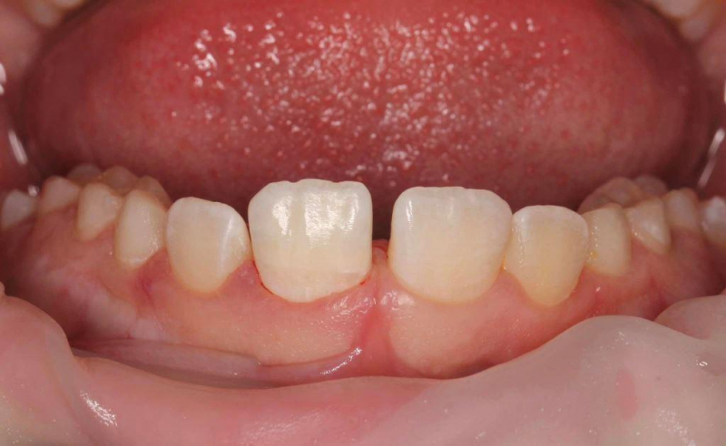 Травма зуба со вскрытием нерва