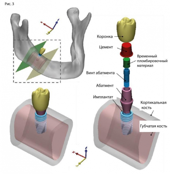 Влияние высоты коронки и соединения абатмента на биомеханическую стабильность имплантатов с внутренним соединением в раннем и отдаленном послеоперационном периоде