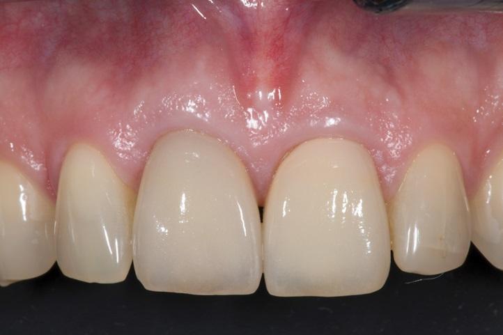 Биологический взгляд на использование частичной экстракционной терапии (частичного удаления зубов) в имплантологии