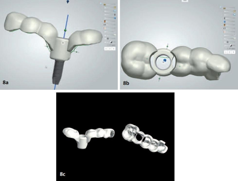 Направленный хирургический имплантат в кратчайшие сроки: использование данных конусно-лучевой компьютерной томографии и сканирования поверхности дефекта