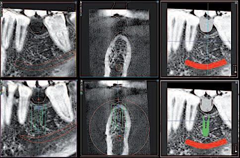 Направленный хирургический имплантат в кратчайшие сроки: использование данных конусно-лучевой компьютерной томографии и сканирования поверхности дефекта