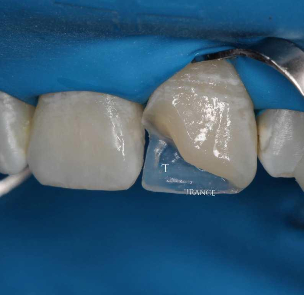 Неосложненная травма 21 зуба
