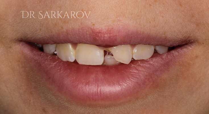 Неосложненная травма 21 зуба