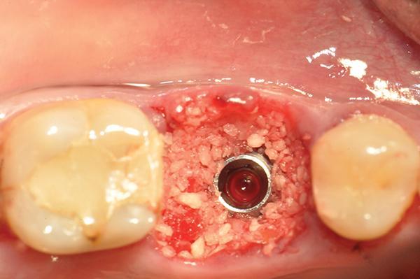 Остеоденсификация эффективна для немедленной замены коренных зубов