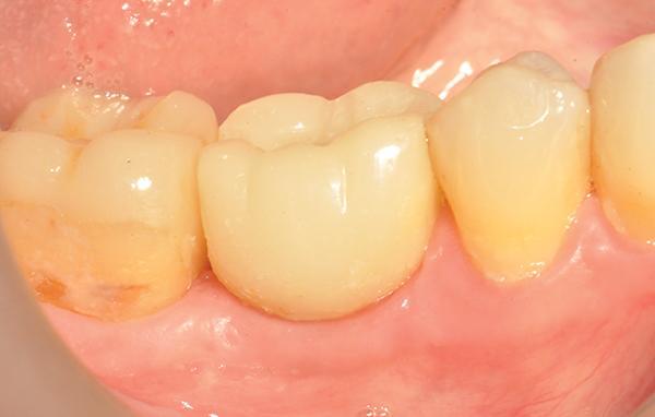 Остеоденсификация эффективна для немедленной замены коренных зубов